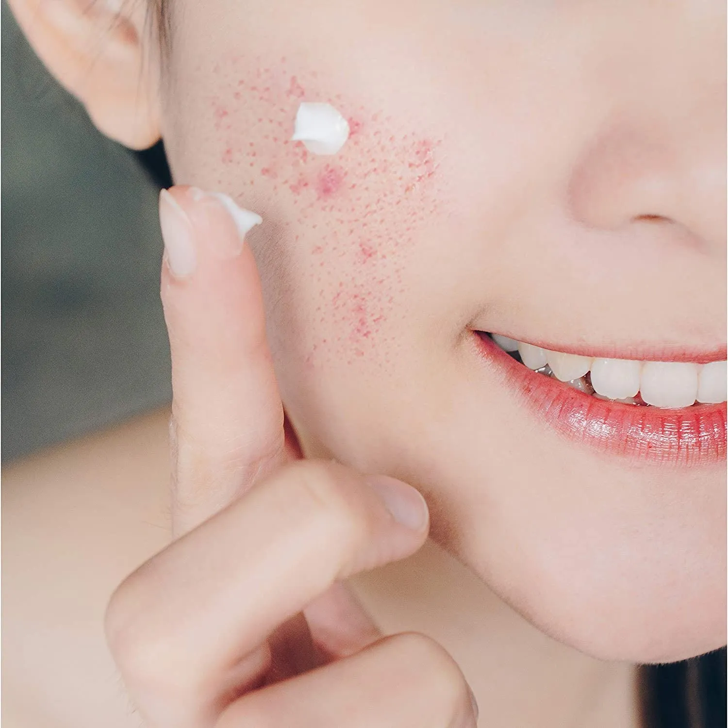 Chấm Mụn Zapzyt 10% Benzoyl Peroxide Gel 28g